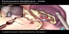 Laparoscopic splenectomy surgery