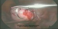 Myomectomy Laparoscopic
