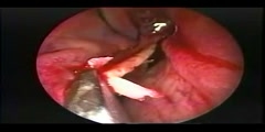 Endoscopic Nasal Septoplasty Surgery