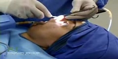 Closed rhinoplasty exposing the nasal structures