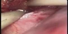 Laparoscopic Adrenalectomy Procedure