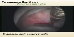 India- Endoscopic Brain Surgery