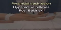 Tendon reflexes demonstrated