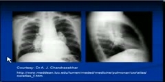 Sarcoidosis- Chest x-ray interpretation