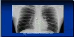 Chest x-ray Superior mediastinal structures