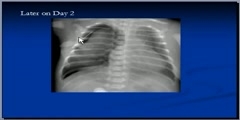 Chest x-ray interpretation, RDS Tutorial