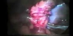 How to Perform the Laparoscopic Appendectomy for Appendicitis?