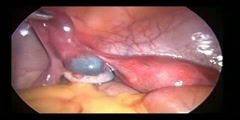 Fallopian tube diverticulus treatment