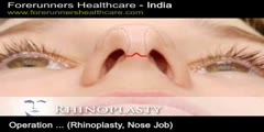 Live nose job surgery in India