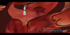 Cardiology Medical Animation - Deployment of mitral valve clip