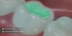 Tooth Decay Treatment