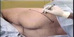 Sciatic Nerve Block