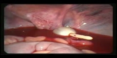 Repairing of Urinary Bladder