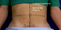 Palpation for Abdominal Masses