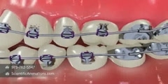 How to brush with braces?