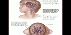 Video of Hydrocephalus